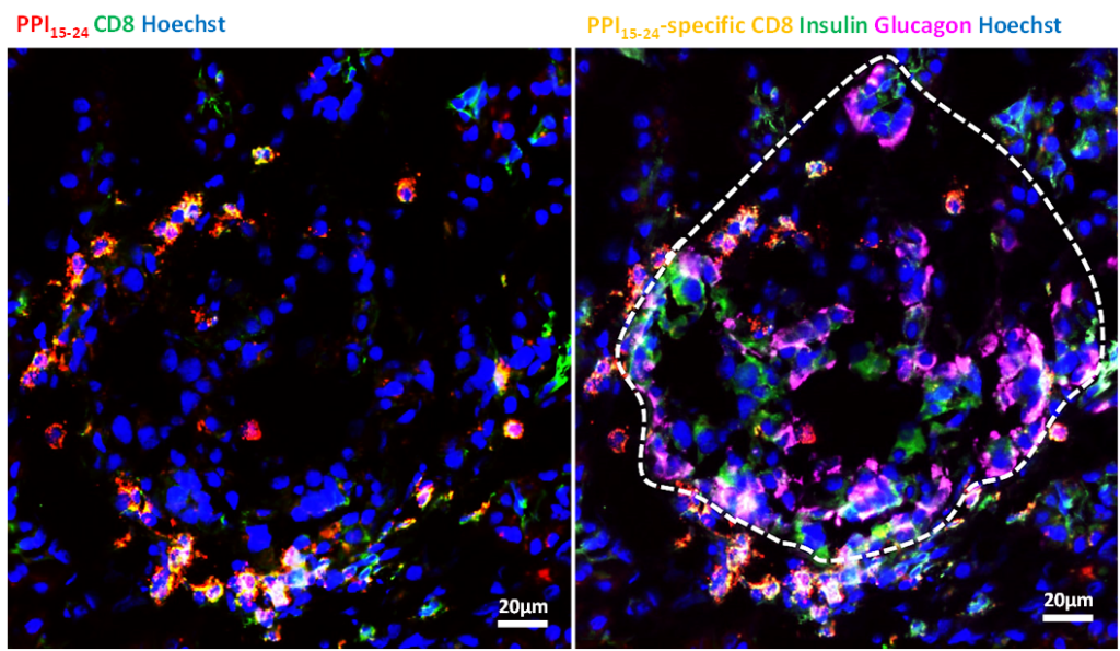 Yellow staining shows CD*+T cells poised to target preproinsulin. The white outline on the right shows the perimeter of an insulin-containing islet in a patient with type 1 diabetes. The image shows that the preproinsulin-specific T cells can wait very close islets, probably poised to destroy the beta cells inside. Courtesy of Von Herrath Lab, La Jolla Institute for Immunology